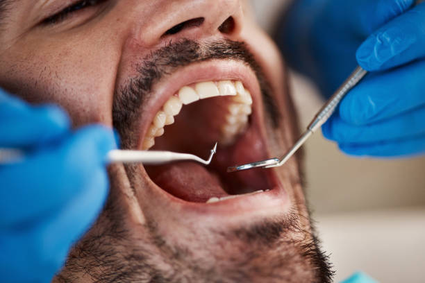 Best Knocked-Out Tooth (Avulsed Tooth) Treatment in Sublette, KS